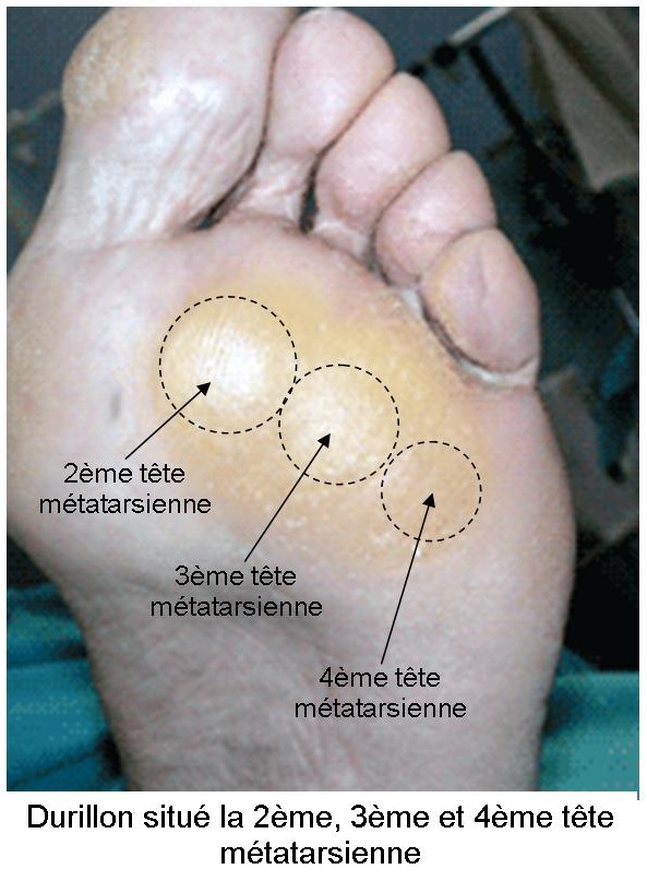 Semelle plante 2024 des pieds